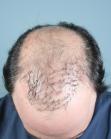 Before Hair Transplant&nbsp;Revision